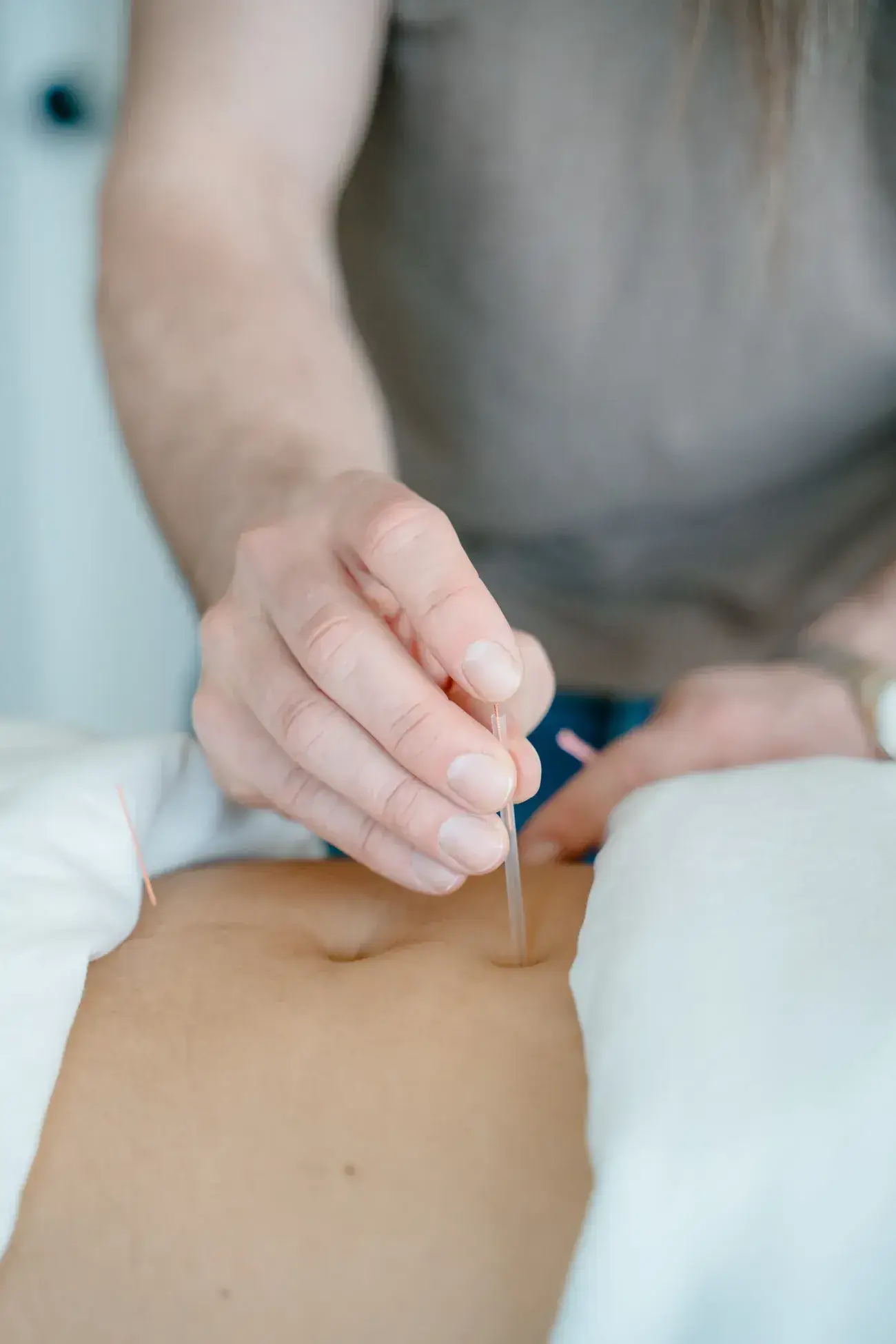 An acupuncture needle being placed at a point on the abdomen at Renu in Calgary